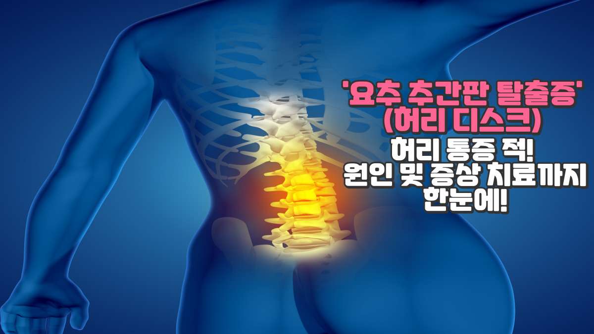 요추 추간판 탈출증(허리 디스크)허리 통증 적! 원인 및 증상 치료법