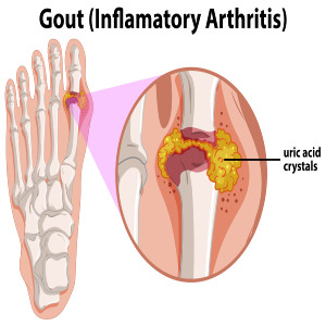 통풍(Gout), 식습관이 바뀌면서 흔하게 발생하는 병.