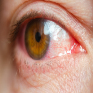 결막염 예방과 관리 - 눈의 건강을 지키는 법