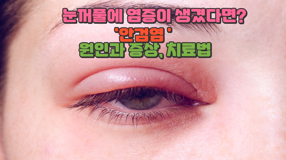 눈꺼풀에 염증이 생겼다면? 안검염 원인과 증상, 치료법 정리